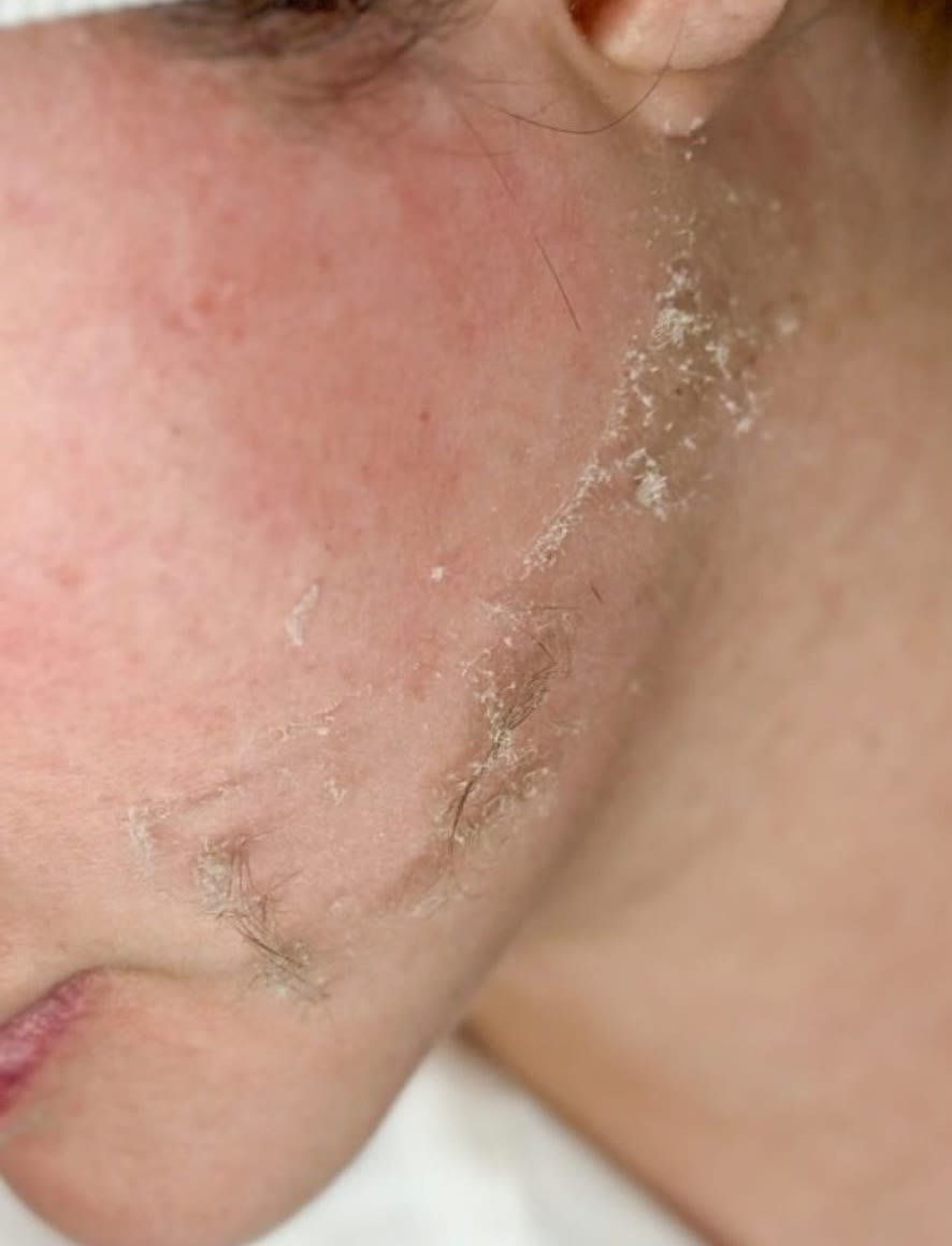 Dermaplaning Schritt im Korean Facial