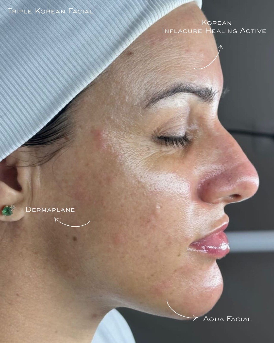 Nachher Triple Korean Facial Chur