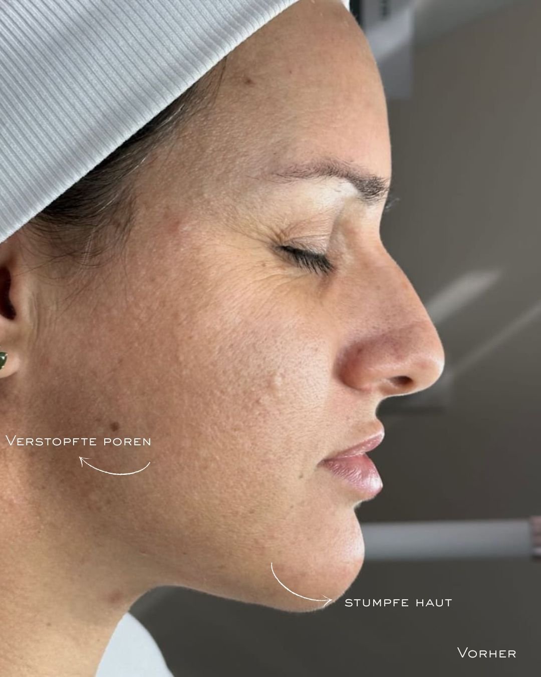 Vorher Korean Facial Chur