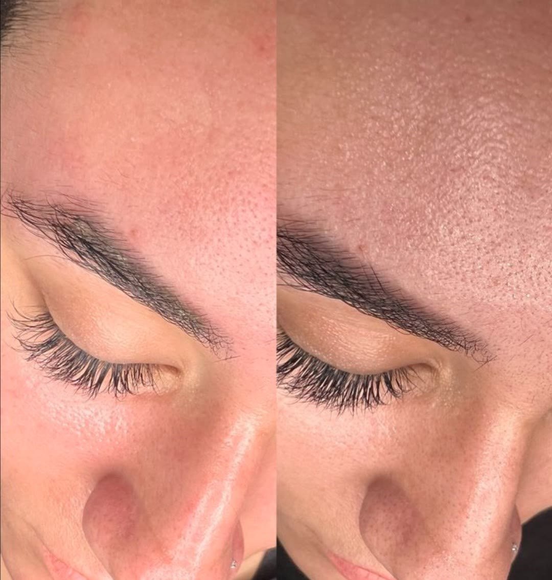 Korean Facial Glow vorher nachher