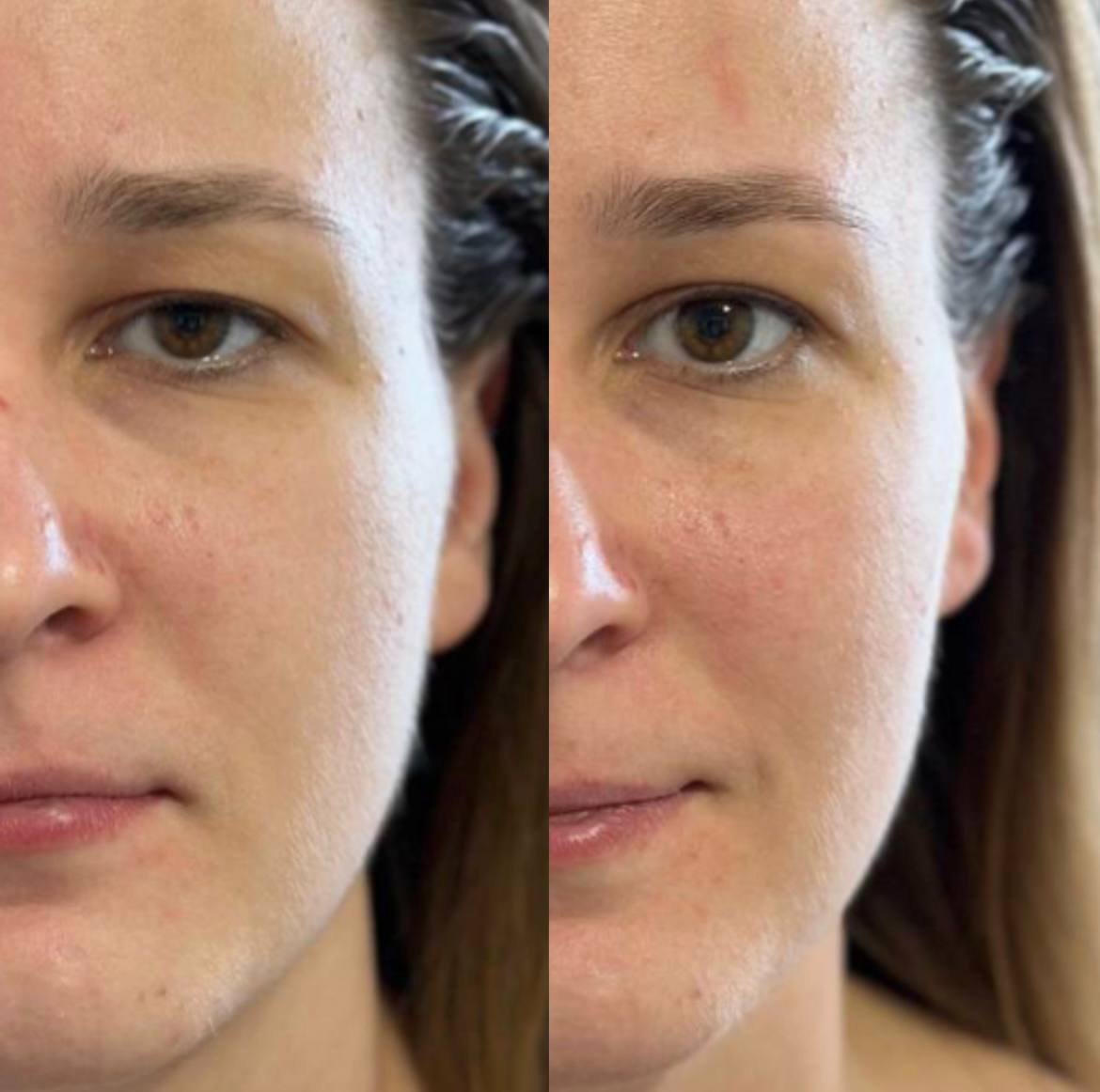 Peeling vorher nachher Chur